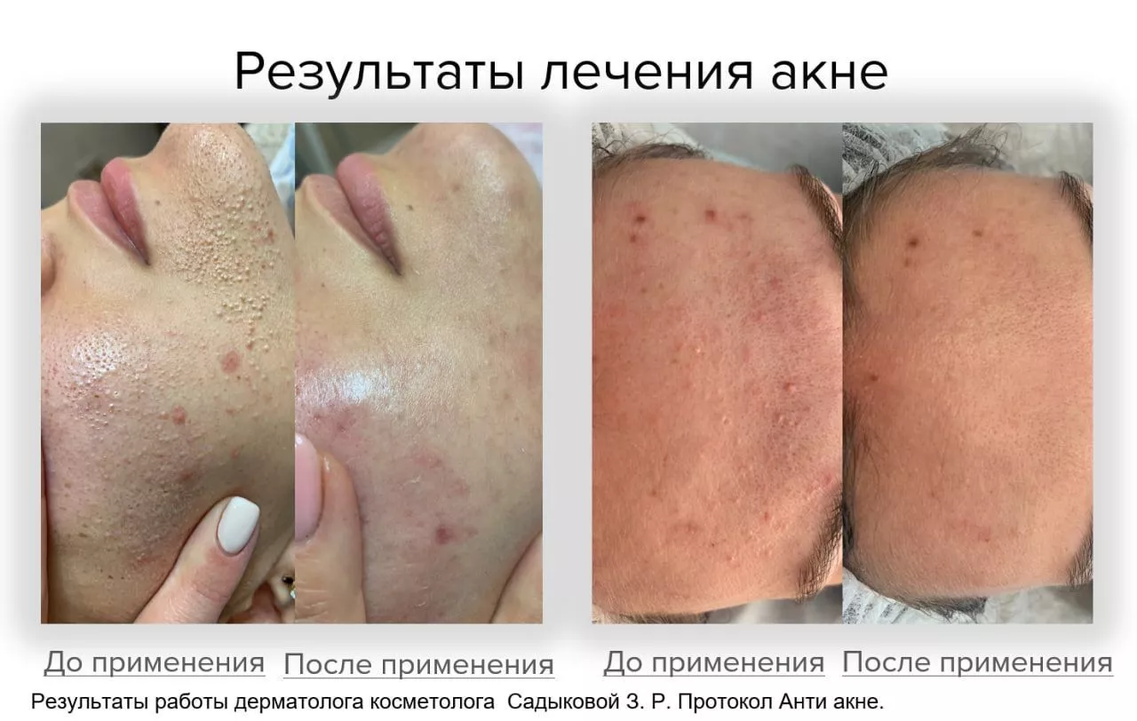 Мягкий очищающий гель Gentle Cleanser Free From Malassezia